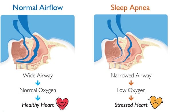 Sleep apnea นอนกรน หยุดหายใจ