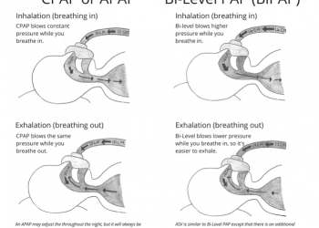CPAP กับ BiPAP ต่างกันอย่างไร