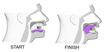 E2 มาออกกำลังกาย บริหารลิ้น ลดภาวะหยุดหายใจตอนนอน (Sleep Apnea) กัน 2