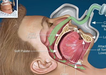 ปัญหาการใช้เครื่อง CPAP
