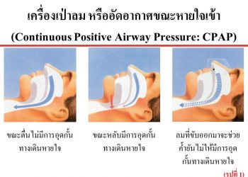 การรักษาโรคนอนกรนและการหยุดหายใจขณะนอนหลับ