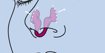 ที่หนีบจมูก แก้นอนกรน