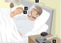 สายรัดหน้ากาก CPAP (Headgear)
