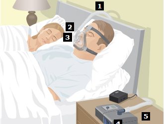 สายรัดหน้ากาก CPAP (Headgear)