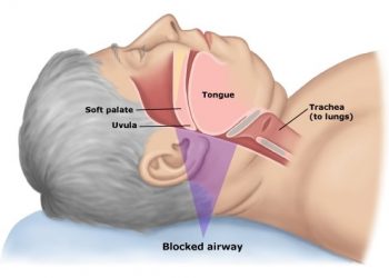 sleep apnea syndrome คือ อะไร