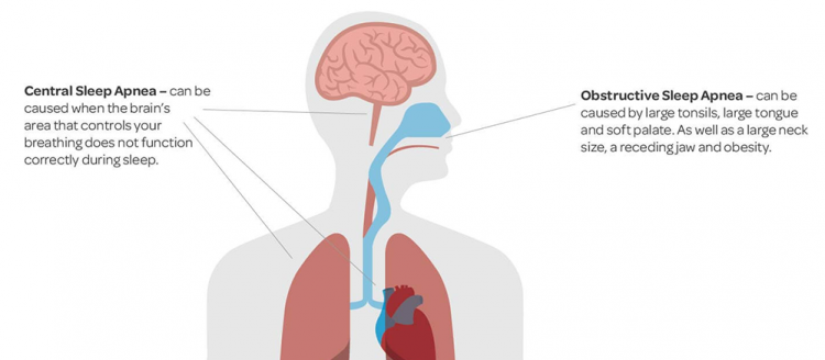 ภาวะหยุดหายใจขณะหลับ ภาษาอังกฤษ
